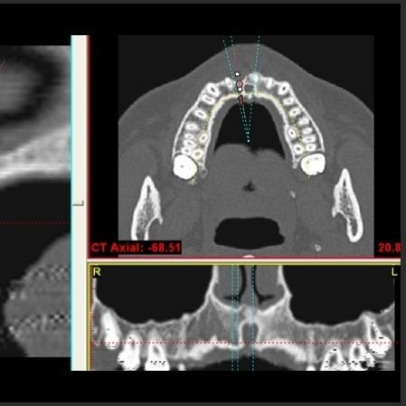 3D電腦斷層微創植牙