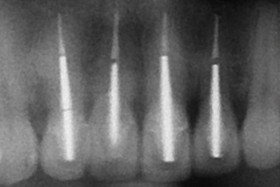 proimages/case/3D-01.png proimages/Case/dentalimplant/01/02/pic_case-01.jpg