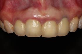 proimages/case/3D-02.png proimages/Case/dentalimplant/01/02/pic_case-02.jpg