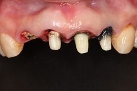 proimages/case/3D-02.png proimages/Case/dentalimplant/01/02./pic_case-03.jpg