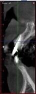 proimages/case/3D-02.png proimages/Case/dentalimplant/01/02/pic_case-06.jpg