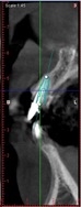 proimages/case/3D-02.png proimages/Case/dentalimplant/01/02/pic_case-07.jpg
