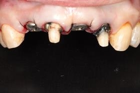proimages/case/3D-02.png proimages/Case/dentalimplant/01/02/pic_case-08.jpg