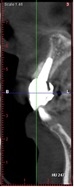 proimages/case/3D-02.png proimages/Case/dentalimplant/01/02/pic_case-09.jpg