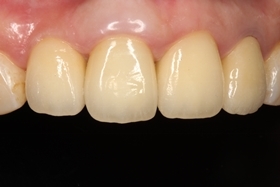 proimages/case/3D-02.png proimages/Case/dentalimplant/01/02/pic_case-11.jpg