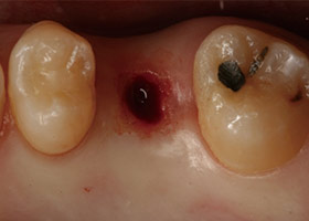 proimages/case/3D-02.png proimages/Case/dentalimplant/02/Laser03-1.jpg