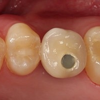 雷射微創植牙