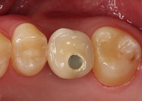 proimages/case/3D-02.png proimages/Case/dentalimplant/02/Laser03-2.jpg
