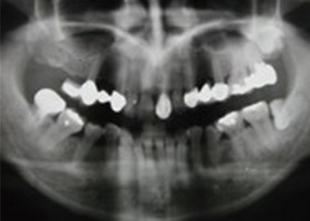 proimages/case/3D-01.png proimages/Case/dentalimplant/03/01/immeditaly01.jpg