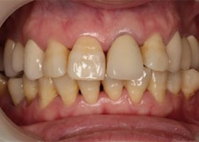 proimages/case/3D-01.png proimages/Case/dentalimplant/03/01/immeditaly02.jpg