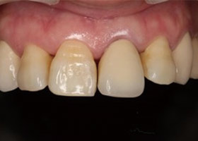 proimages/case/3D-01.png proimages/Case/dentalimplant/03/01/immeditaly03.jpg