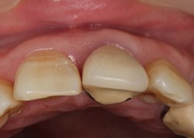 proimages/case/3D-01.png proimages/Case/dentalimplant/03/01/immeditaly04.jpg