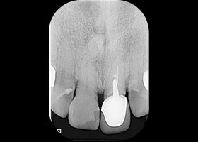 proimages/case/3D-01.png proimages/Case/dentalimplant/03/01/immeditaly05.jpg