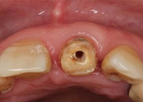 proimages/case/3D-01.png proimages/Case/dentalimplant/03/01/immeditaly06.jpg