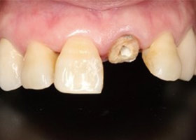 proimages/case/3D-01.png proimages/Case/dentalimplant/03/01/immeditaly07.jpg