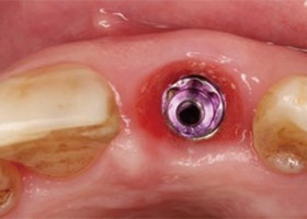 proimages/case/3D-01.png proimages/Case/dentalimplant/03/01/immeditaly08.jpg