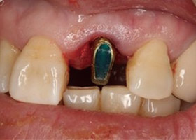 proimages/case/3D-01.png proimages/Case/dentalimplant/03/01/immeditaly09.jpg