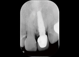 proimages/case/3D-01.png proimages/Case/dentalimplant/03/01/immeditaly11.jpg