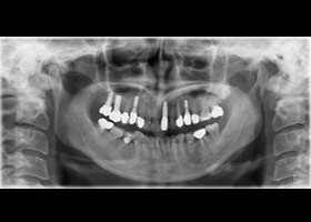 proimages/case/3D-01.png proimages/Case/dentalimplant/03/01/immeditaly12.jpg