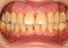 proimages/case/3D-01.png proimages/Case/dentalimplant/03/01/immeditaly13.jpg
