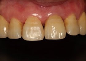 proimages/case/3D-01.png proimages/Case/dentalimplant/03/01/immeditaly14.jpg