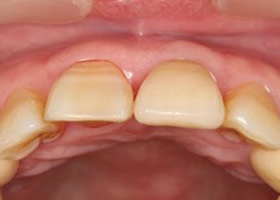 proimages/case/3D-01.png proimages/Case/dentalimplant/03/01/immeditaly15.jpg