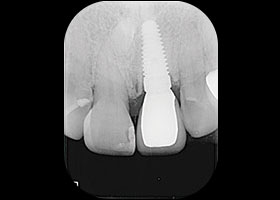 proimages/case/3D-01.png proimages/Case/dentalimplant/03/01/immeditaly16.jpg