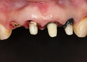 proimages/case/3D-01.png proimages/Case/dentalimplant/03/02/imed03.jpg
