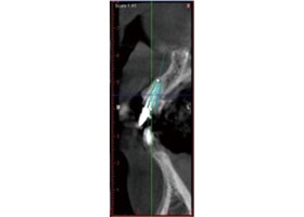 proimages/case/3D-01.png proimages/Case/dentalimplant/03/02/imed06.jpg