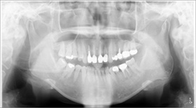 proimages/Case/dentalimplant/03/03/laserteeth01.jpg