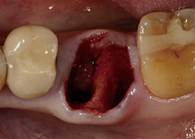proimages/Case/dentalimplant/03/03/laserteeth02.jpg