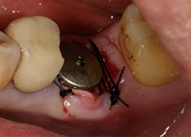 proimages/Case/dentalimplant/03/03/laserteeth03.jpg
