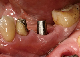 proimages/Case/dentalimplant/03/03/laserteeth04.jpg