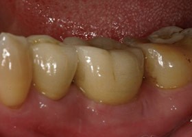 proimages/Case/dentalimplant/03/03/laserteeth05.jpg