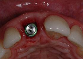 proimages/Case/dentalimplant/05/01/be-2.jpg