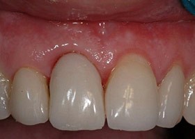 proimages/Case/dentalimplant/05/01/be-4.jpg