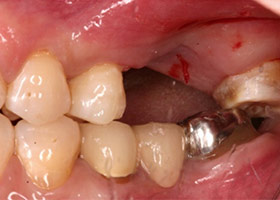 proimages/Case/dentalimplant/06/tr-1.jpg