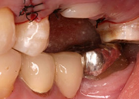 proimages/Case/dentalimplant/06/tr-3.jpg