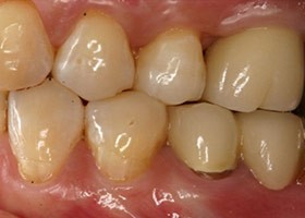 proimages/Case/dentalimplant/06/tr-4.jpg