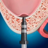 上頷竇微創增高手術