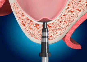 proimages/case/3D-01.png proimages/Case/dentalimplant/07/top01.jpg