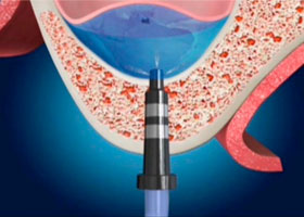 proimages/case/3D-01.png proimagesCase/dentalimplant/07/top02.jpg