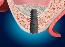 proimages/case/3D-01.png proimages/Case/dentalimplant/07/top03.jpg
