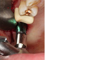 proimages/case/3D-01.png proimages/Case/dentalimplant/07/topcase03.jpg