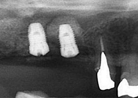 proimages/case/3D-01.png proimages/Case/dentalimplant/07/topcase04.jpg