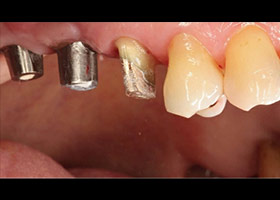 proimages/case/3D-01.png proimages/Case/dentalimplant/07/topcase05.jpg