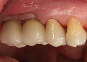 proimages/case/3D-01.png proimages/Case/dentalimplant/07/topcase06.jpg