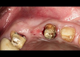 proimages/case/3D-01.png proimages/Case/dentalimplant/08/serious1.jpg