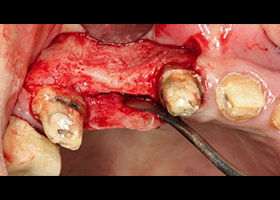 proimages/case/3D-01.png proimages/Case/dentalimplant/08/serious2.jpg