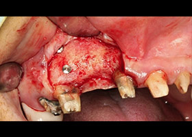 proimages/case/3D-01.png proimages/Case/dentalimplant/08/serious4.jpg